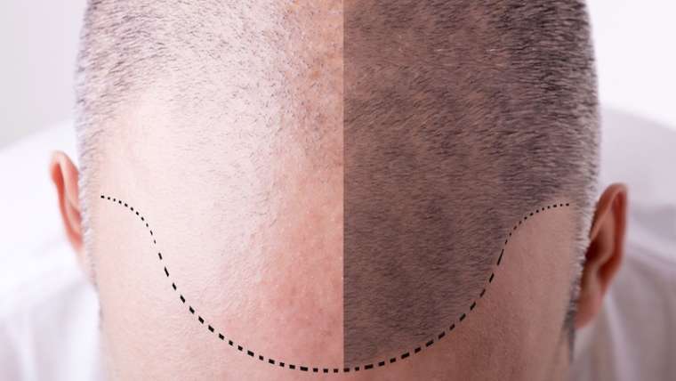 Trapianto capelli